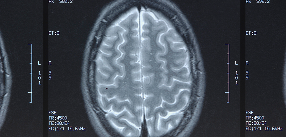 뇌신경 질환 검사사진